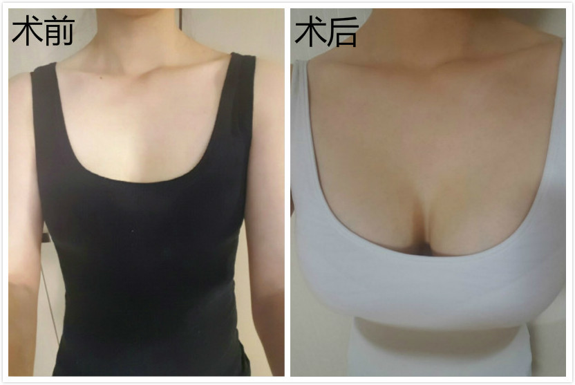 假体隆胸250高凸,曼托225cc和250效果图 假体隆胸第242天