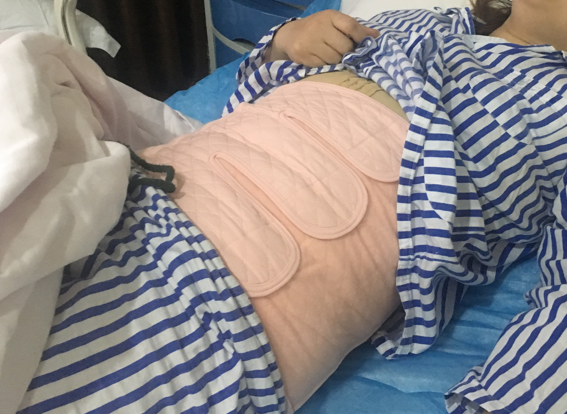 【合肥童颜堂整形美容腰腹吸脂术后2天操作医生:周冬】第一天很难受