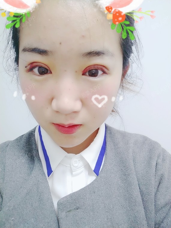 卡卡卡的卡卡切开双眼皮第4天美丽日记-新氧美