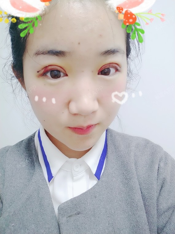 卡卡卡的卡卡切开双眼皮第4天美丽日记-新氧美