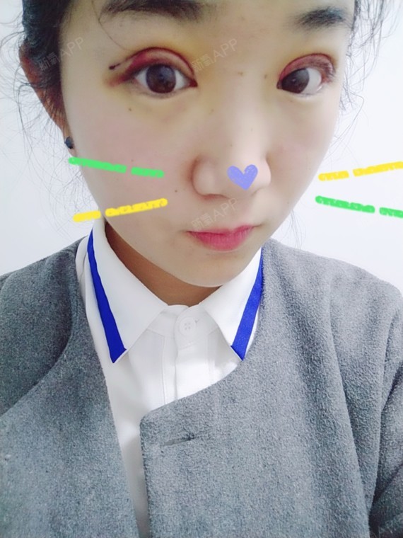 卡卡卡的卡卡切开双眼皮第4天美丽日记-新氧美