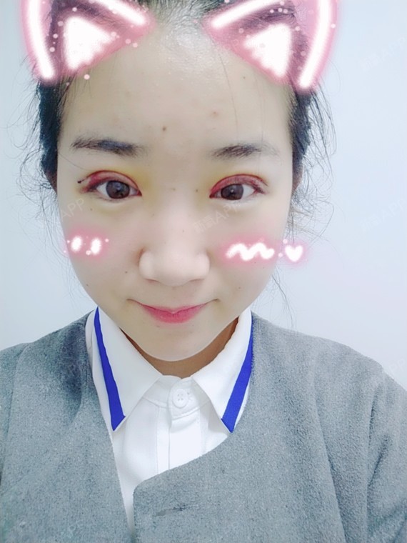 卡卡卡的卡卡切开双眼皮第4天美丽日记-新氧美