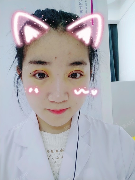 卡卡卡的卡卡切开双眼皮第4天美丽日记-新氧美