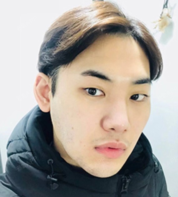 氧气yllfm自体脂肪全脸填充第0天美丽日记-新氧
