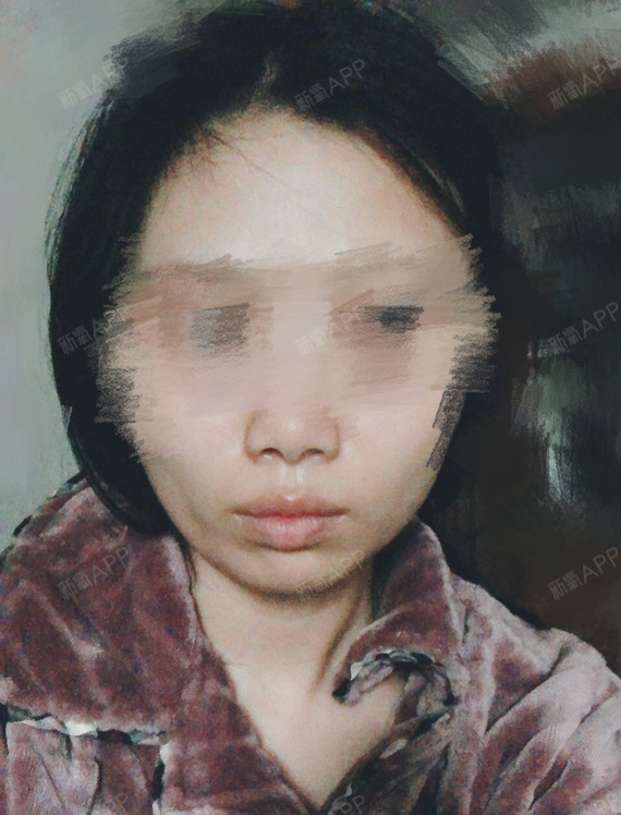 拔牙真的可以瘦!看我照片就知道了!