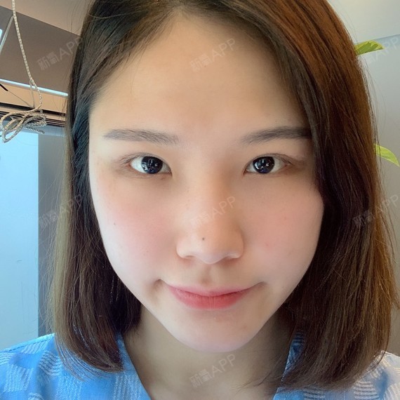 开了外眼角,已经一周啦!