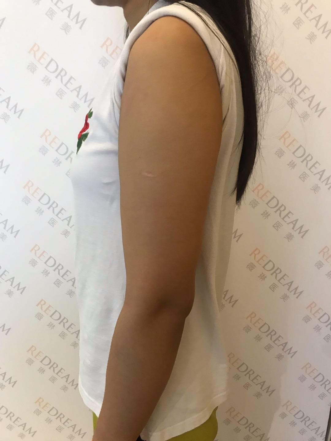 北京薇琳医疗美容医院超声溶脂瘦手臂怎么样_恢复过程