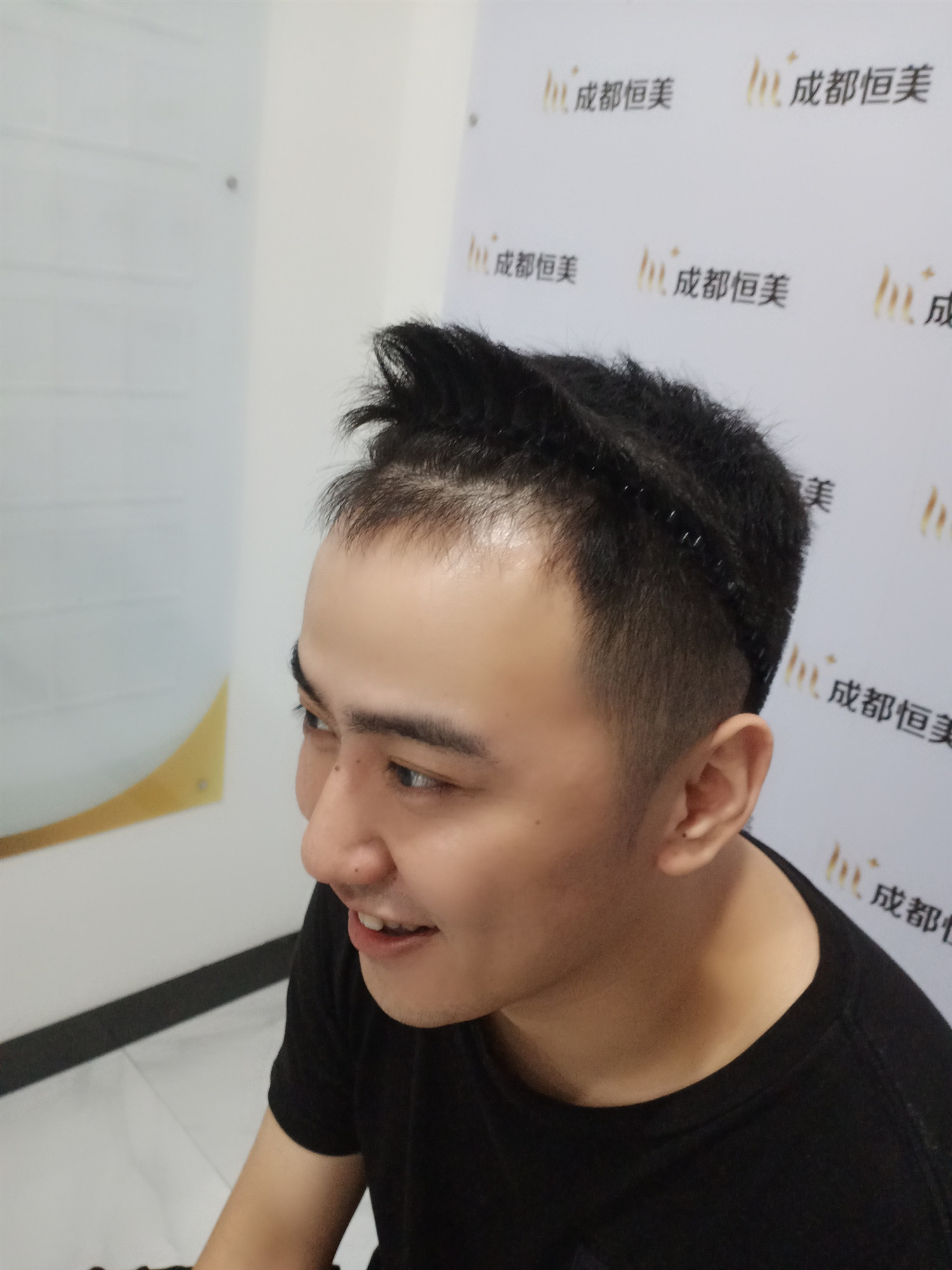 tllsih的美丽日记"6.28"种植鬓角
