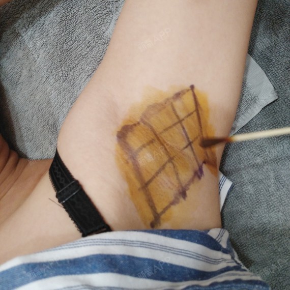 下图是我复查的时候拍的,因为结痂的,上面有一层红红的药膏.