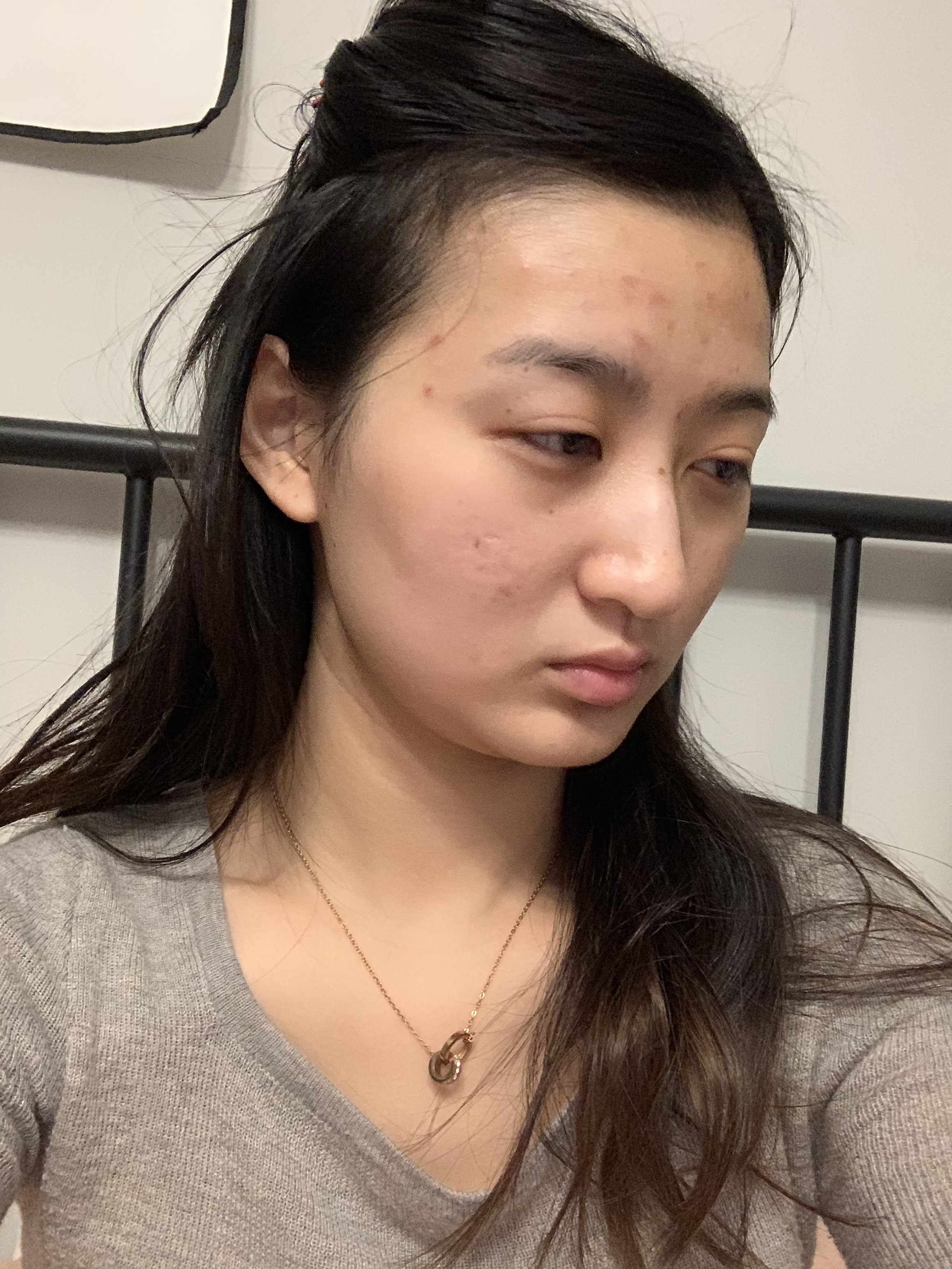氧气4vjep的美丽日记"12.22"面部吸脂