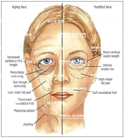 【为什么面部提升手术要与眼部整形一起做?】