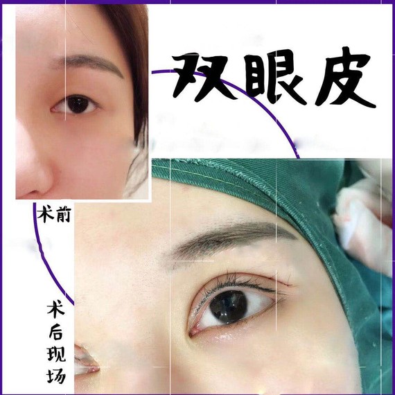 双眼皮成本那么低,凭v成本那么贵?钩针猫图解图片