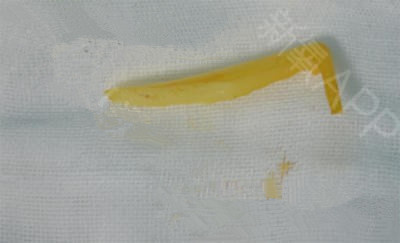 【#奇葩说#隆鼻后鼻子出痘、化脓、出血怎么