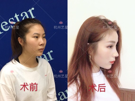 【#奇葩说#隆鼻后鼻子出痘,化脓,出血怎么办?】