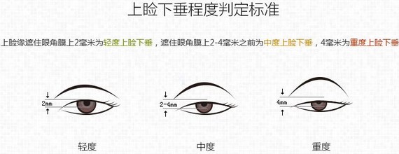 正常的提肌黑眼球几乎不被上眼睑遮挡