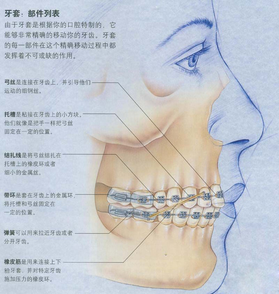 牙套的结构