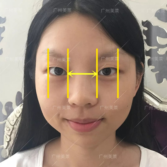 既放大双眼,又能平衡五官  好比西西,眼距很宽显得智力感不足