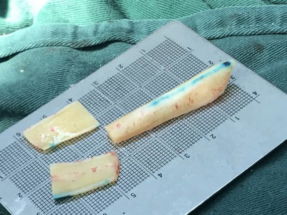 【肋软骨钙化了怎么回事?要怎么做鼻综合整形?】大部分亚洲人的鼻子基础都比_圈子-新氧美容整形