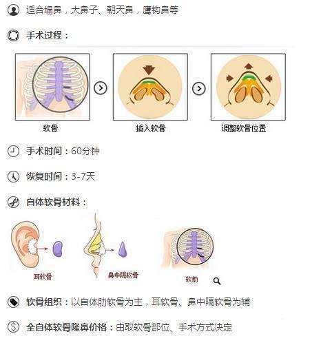 【自体软骨隆鼻科普】术前你需要了解这些