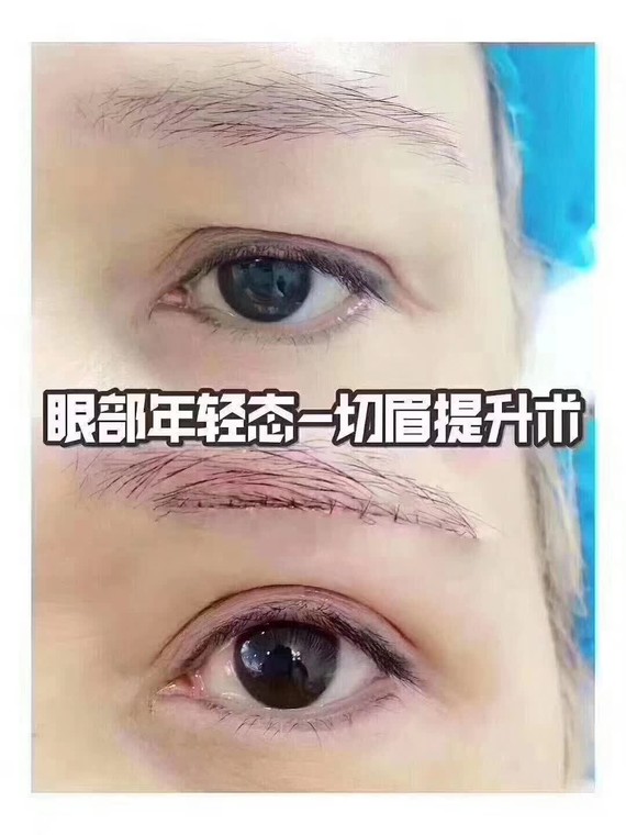 无痕提眉术前后效果,从大妈变大姐术前眉尾下耷,人显老十