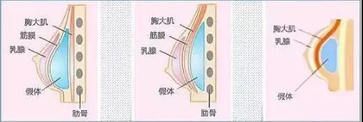 假体隆胸后不能哺乳因为奶水有毒?坐飞机还会爆炸?