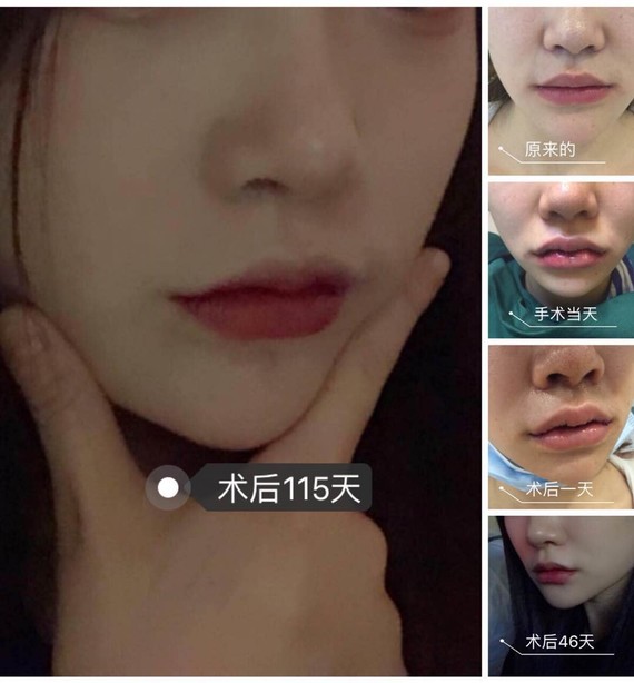 咨询了医生并结合我的面部作出了相应的方案,医生给的建议是做上唇改m