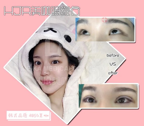 hjr美咖眼综合术后即刻对比～眼型超美～芭比翘睫大眼～达到宝宝想要