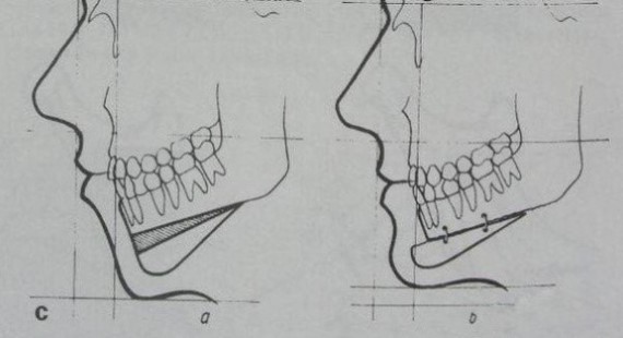 从以下三个点说一说:一、正颌手术包括哪些手