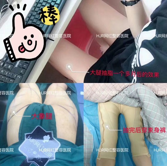 附送宝宝大腿吸脂的一个月效果反馈没有反弹哦最近都是来做
