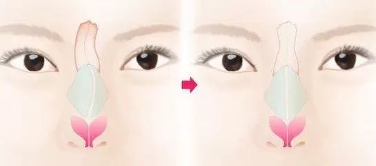 鼻小柱畸形矫正在面部五官中影响最大的部分就
