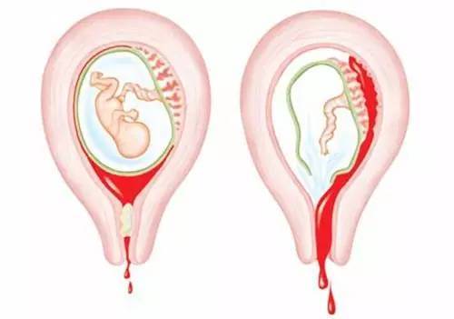人流后需休息几天,人流后吃什么恢复快你都了