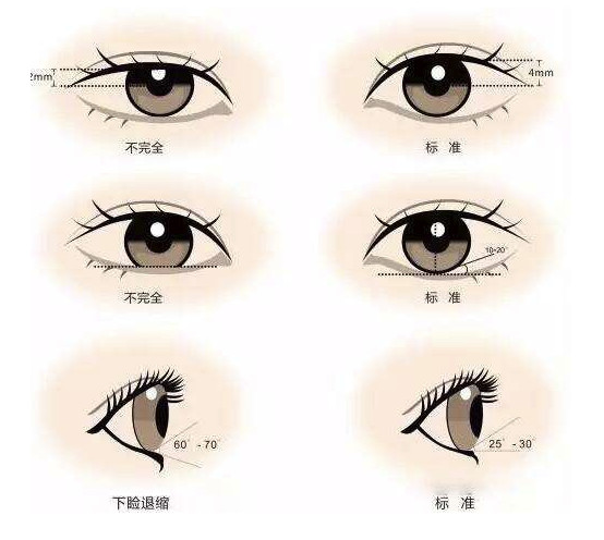 5.内眼角睑裂角为48~55°;外眼角睑裂角为60~70°.