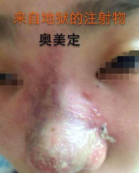 所以注射过 骨粉,微晶瓷,奥美定,生长因子等的患者,应该尽快治疗取出!