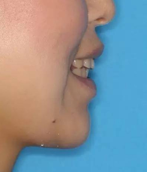 牙齿矫正是如何让脸变小,让下巴变翘的?