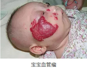 胎记不只是美观问题,还引发7种危害胎记的危害