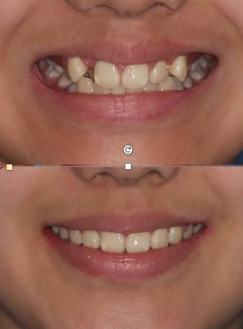 牙齿矫正是如何让脸变小,让下巴变翘的?