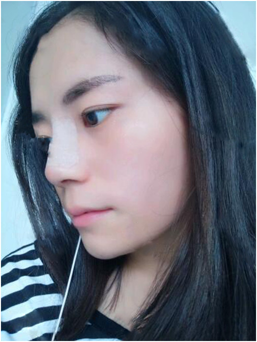 隆鼻手术后多久算完全恢复?