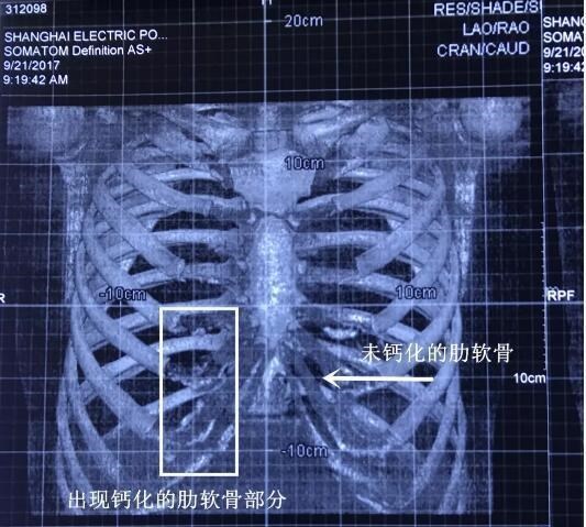 【用“钙化”的肋软骨隆鼻有后遗症吗?】鼻部处于面部中央位置,不挺翘会让整_圈子-新氧美容整形