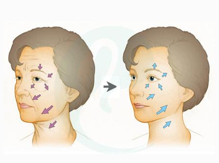 面部提升术后的注意事项1、最好采用温水洗脸