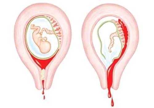 人工流产后多久能上班
