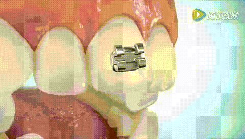 揭秘箍牙全过程,带你亲眼看看牙套是怎么安装的