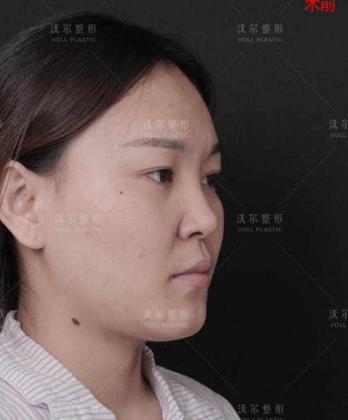 刘彦军团队美小护的自拍反馈,术后马上要一个