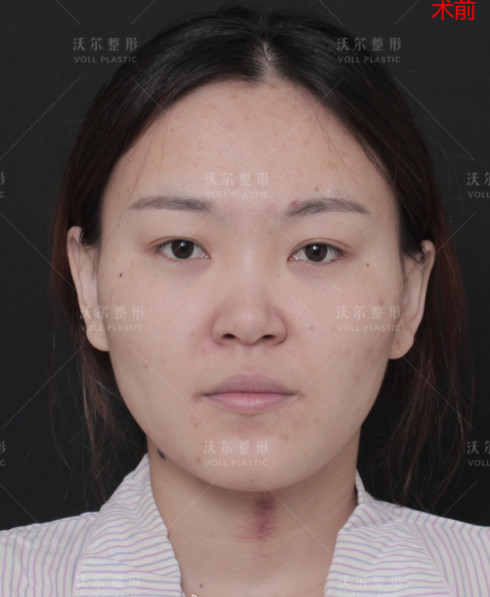 刘彦军团队美小护的自拍反馈,术后马上要一个