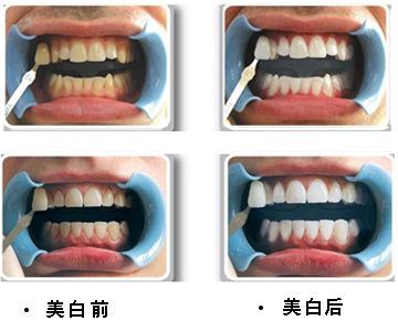 牙齿激光美白你了解吗?效果怎么样?