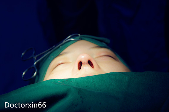 大鼻头,漏鼻孔,都怎么矫正?有专家学者做过调