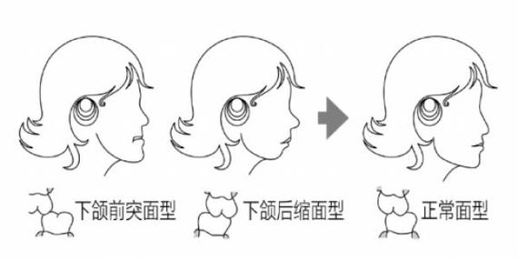 牙齿地包天是怎样一种体验?相信身为地包天"受_圈子-新氧美容整形