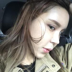 真人案例|鼻综合术后一个月,路人蜕变成萝莉少