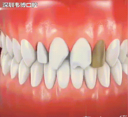 终于明白为什么牙医要建议你做牙齿贴面!牙齿_圈子-新氧美容整形