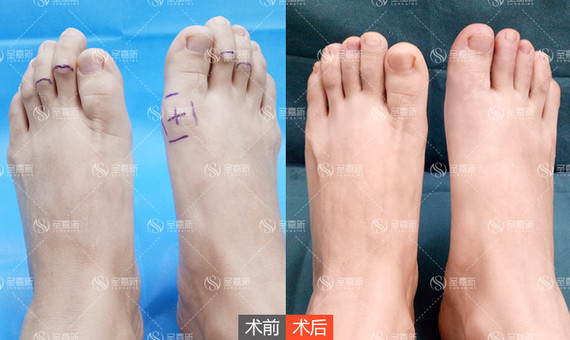 祛大脚骨和长趾缩短手术能不能一起做?