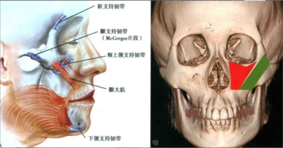 其实有经验的医生都会尽量只剥离截骨范围,颧弓,眶下区软组织尽量少